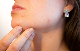 What's Causing Breakouts - And Tips To Get Rid of Them