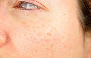 Hyperpigmentation: What Causes It And How to Address It!