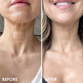 SELF-ESTEEM Neck Firming Lift