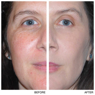 REDNESS REHAB Conceal + Correct