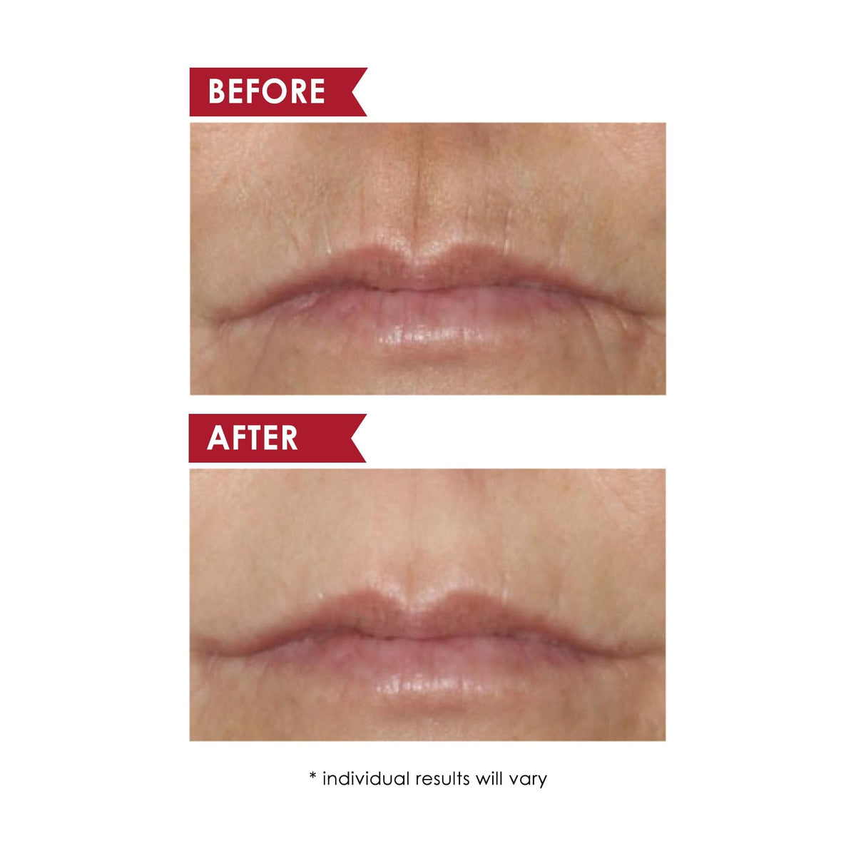 files/1006_SmoothUpperLipPerioralTreatmentPROFESSIONAL-BA__1787123.15.38.jpg
