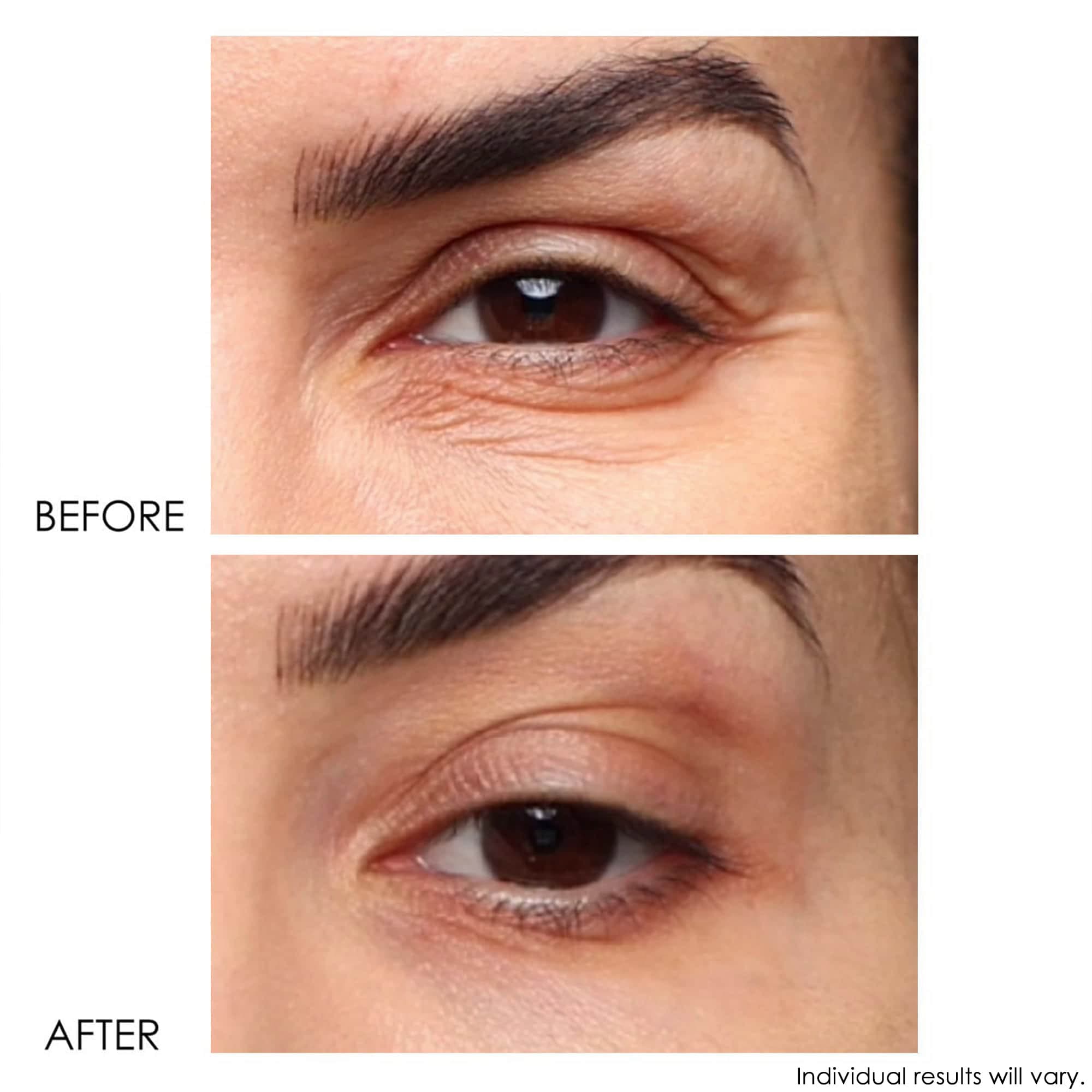 REVITALITE Eyelid & Dark Circle Corrector | 5-in-1 Eye Treatment