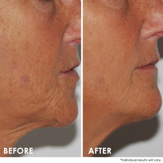 SELF-ESTEEM Neck Firming Lift
