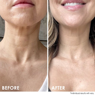 SELF-ESTEEM Neck Firming Lift