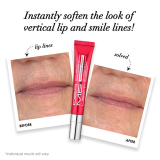 SMOOTH UPPER LIP PROFESSIONAL Perioral Anti-Aging Treatment Before and After